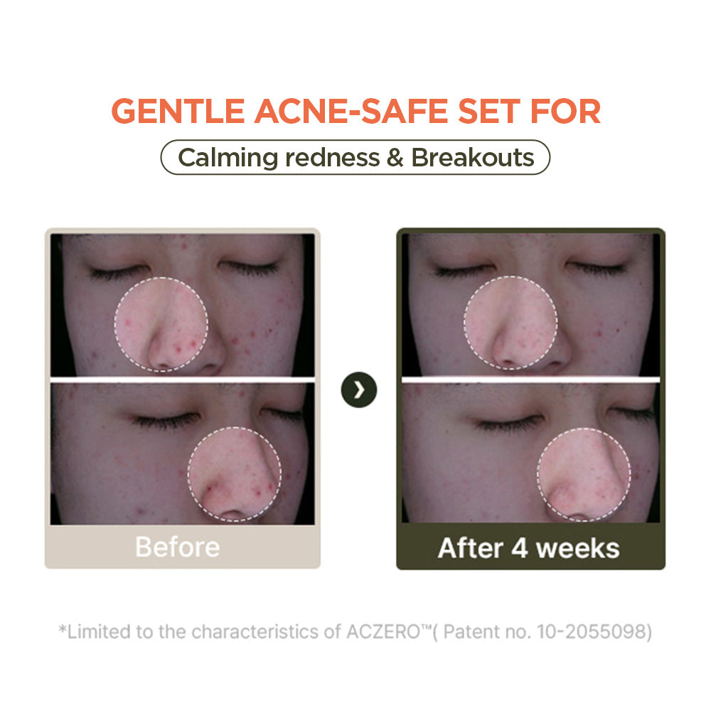 The Anti-Acne Routine Set